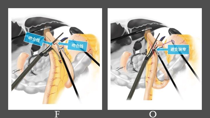 节省了1-2枚吻合钉舱的使用,从而节省费用