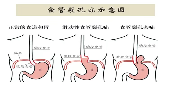 食管裂孔疝是什么病图片