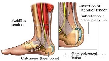  南加大物理治疗系认证课程>培训资料提前预览:跟腱炎 - 好大夫在线