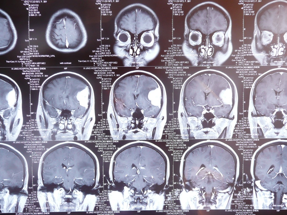 脑膜瘤症状图片