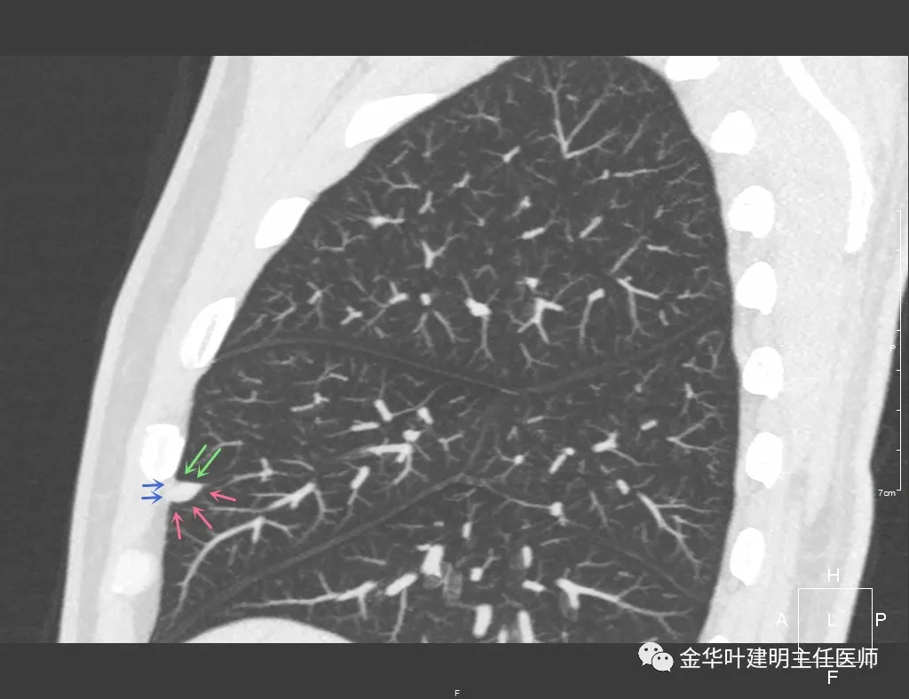 磨玻璃還伴血管穿行的肺結節真的是肺癌嗎