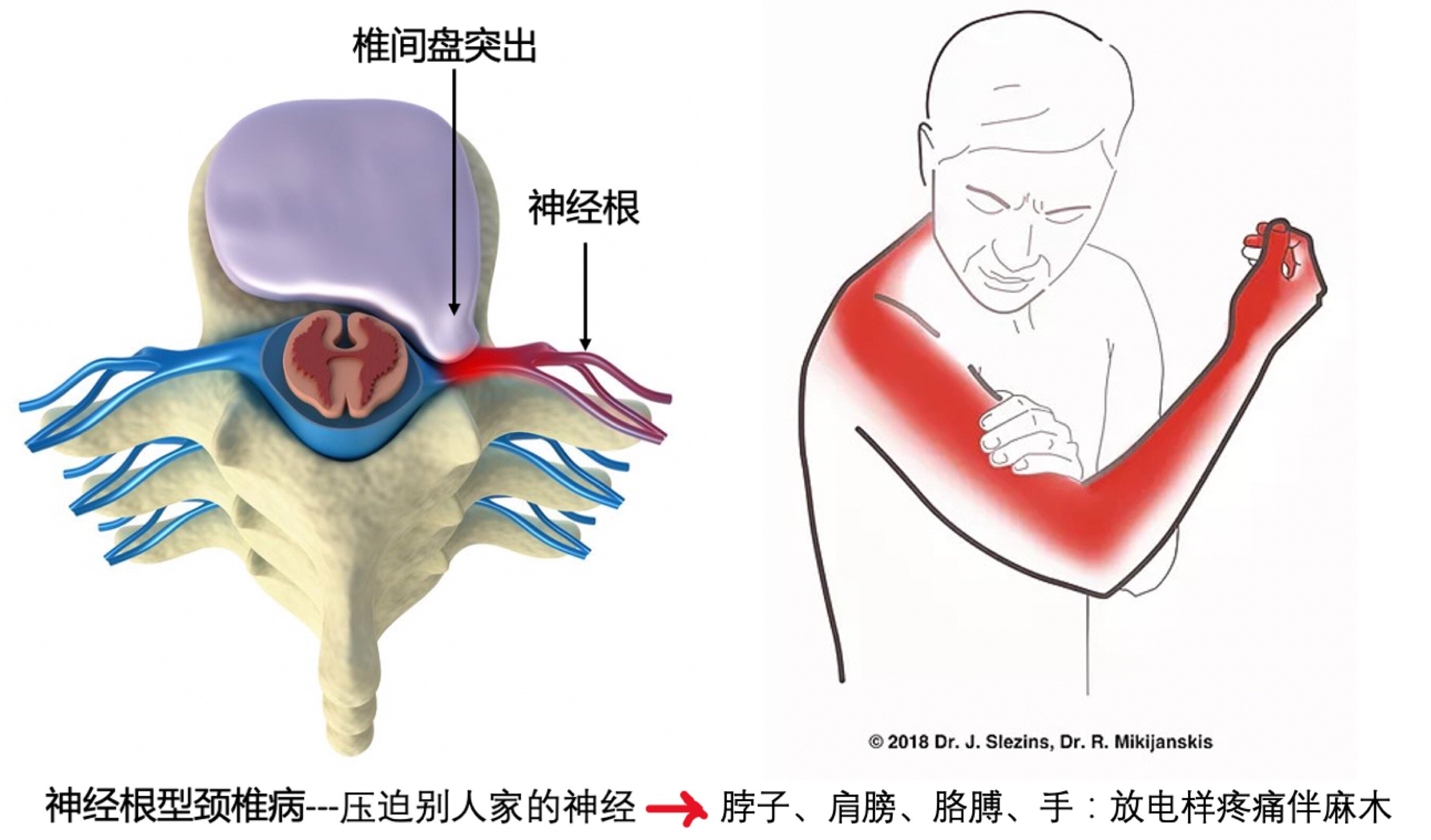 颈椎引起左胸痛位置图图片