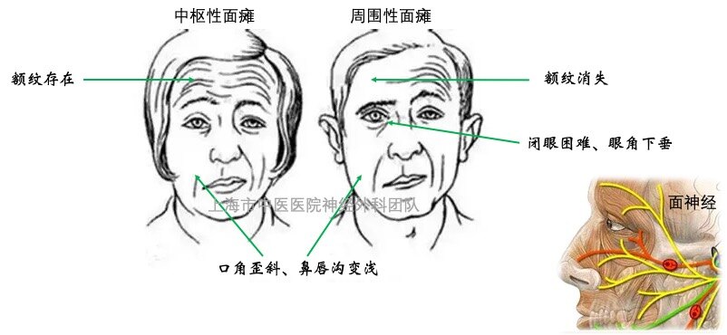 中枢性面神经麻痹图片