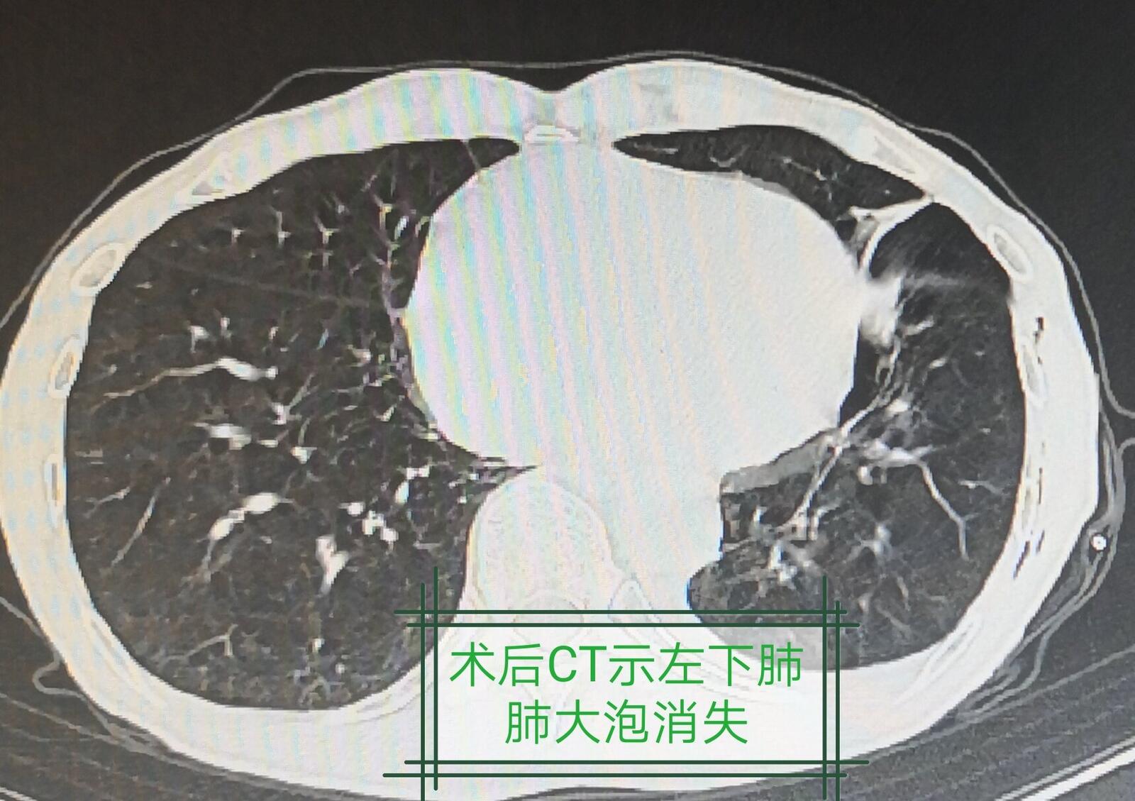 消失的肺大泡內科微創成功治療巨大肺大泡