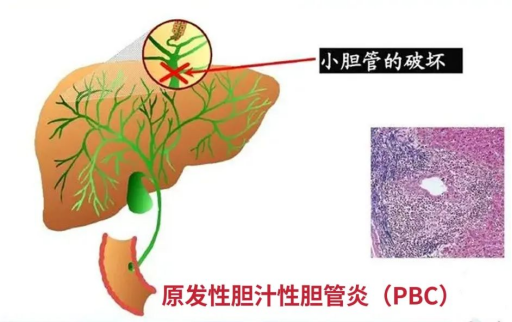 原发性胆汁性胆管炎(primary biliary cholangitis, pbc)_原发性胆汁