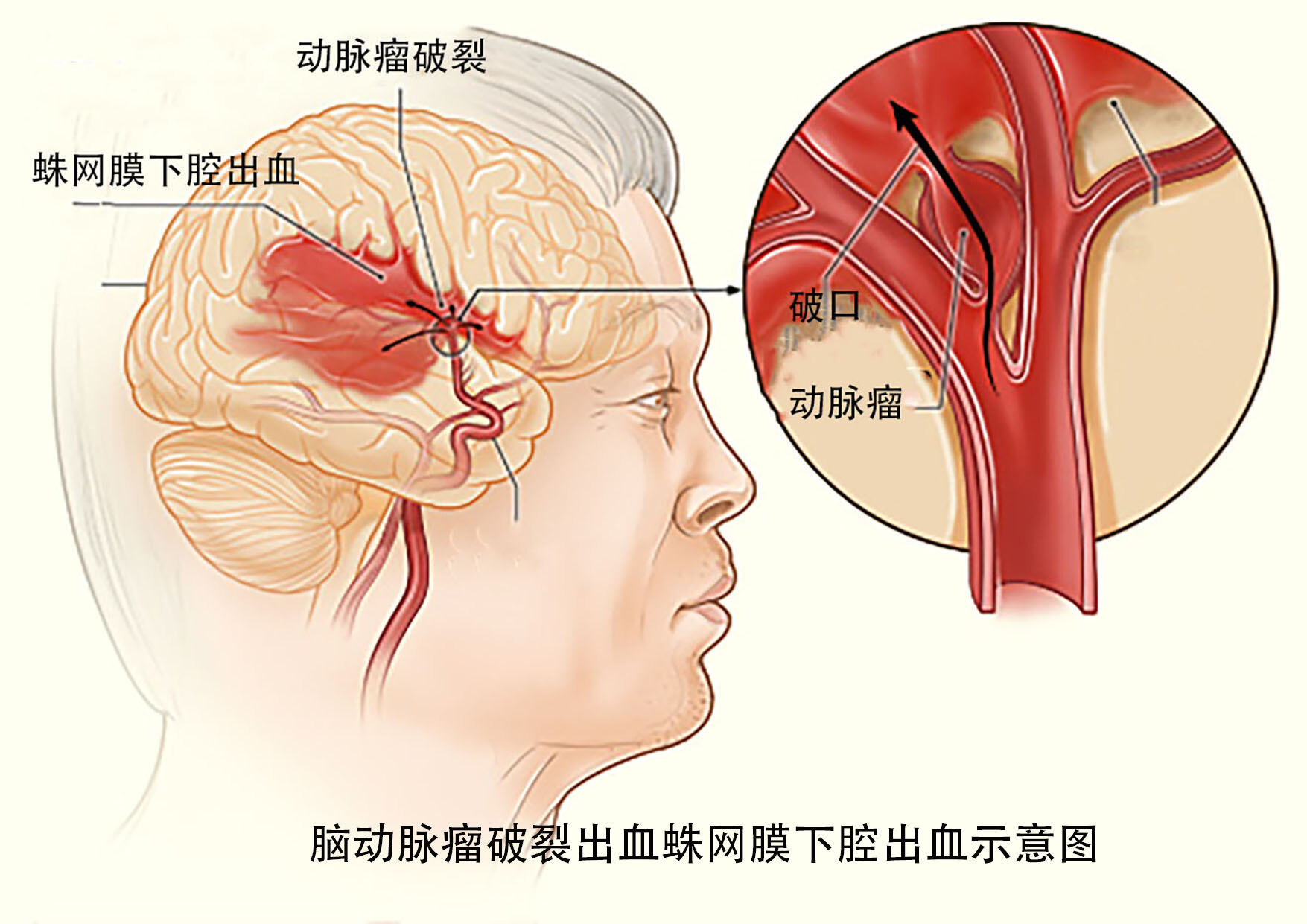 脑动脉瘤破裂后需要尽快治疗