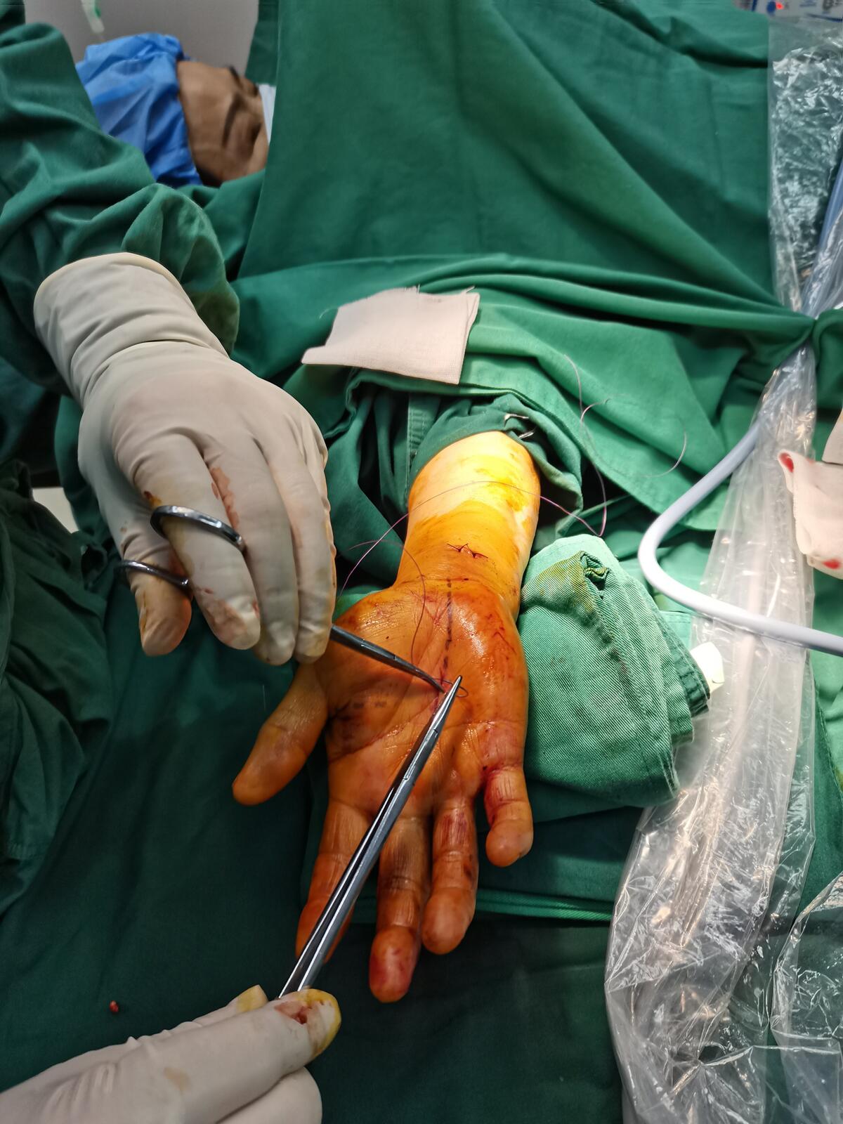 腕管综合征手术过程图图片