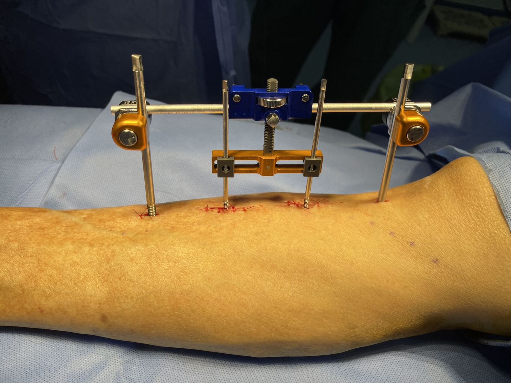 而当糖尿病足患者发展为坏疽时,则会采取截肢治疗,尽量保留功能肢体