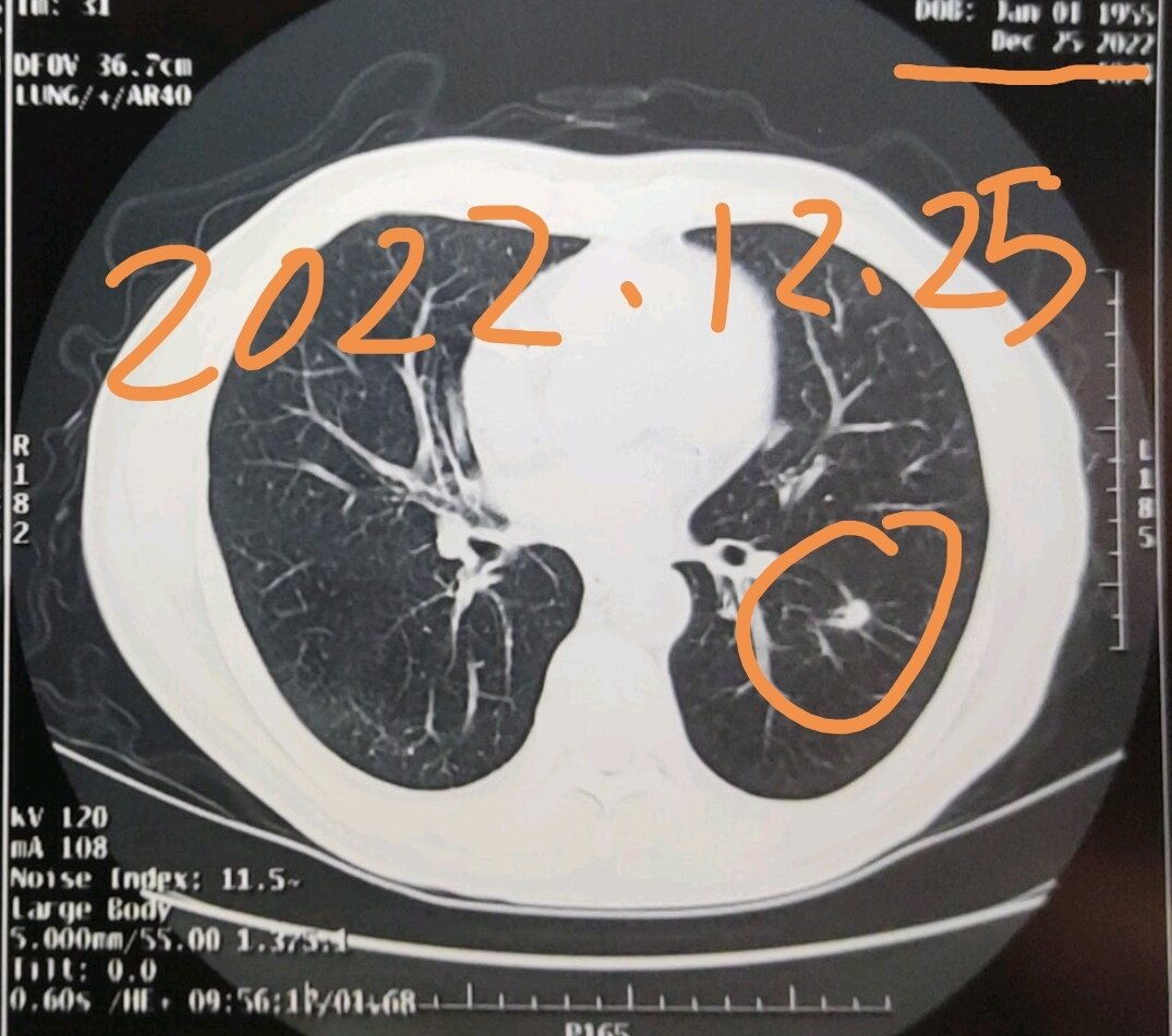 刘懿博士说肺癌（五三二七）当时CT报告没提肺结节，看片子却存在_肺癌_介绍_检查 - 好大夫在线