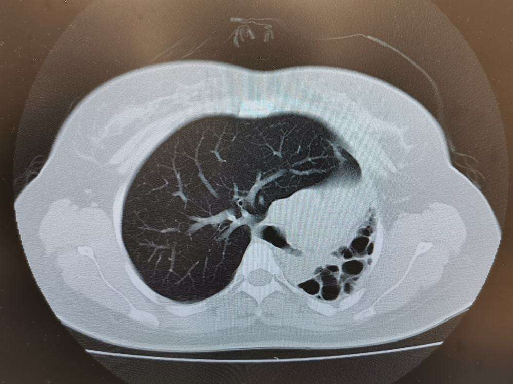 肺结核长什么样图片图片