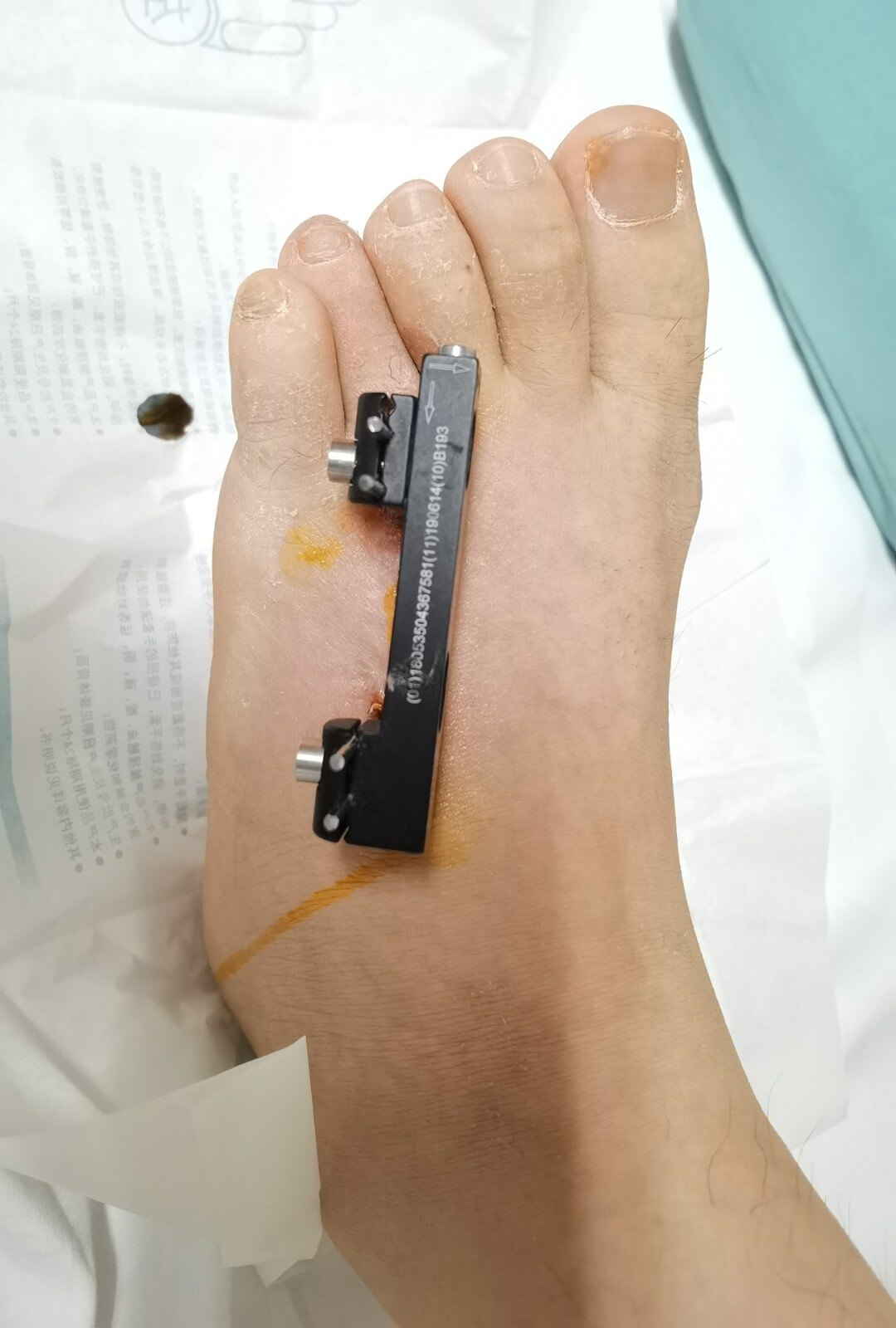 短趾症brachymetatarsia