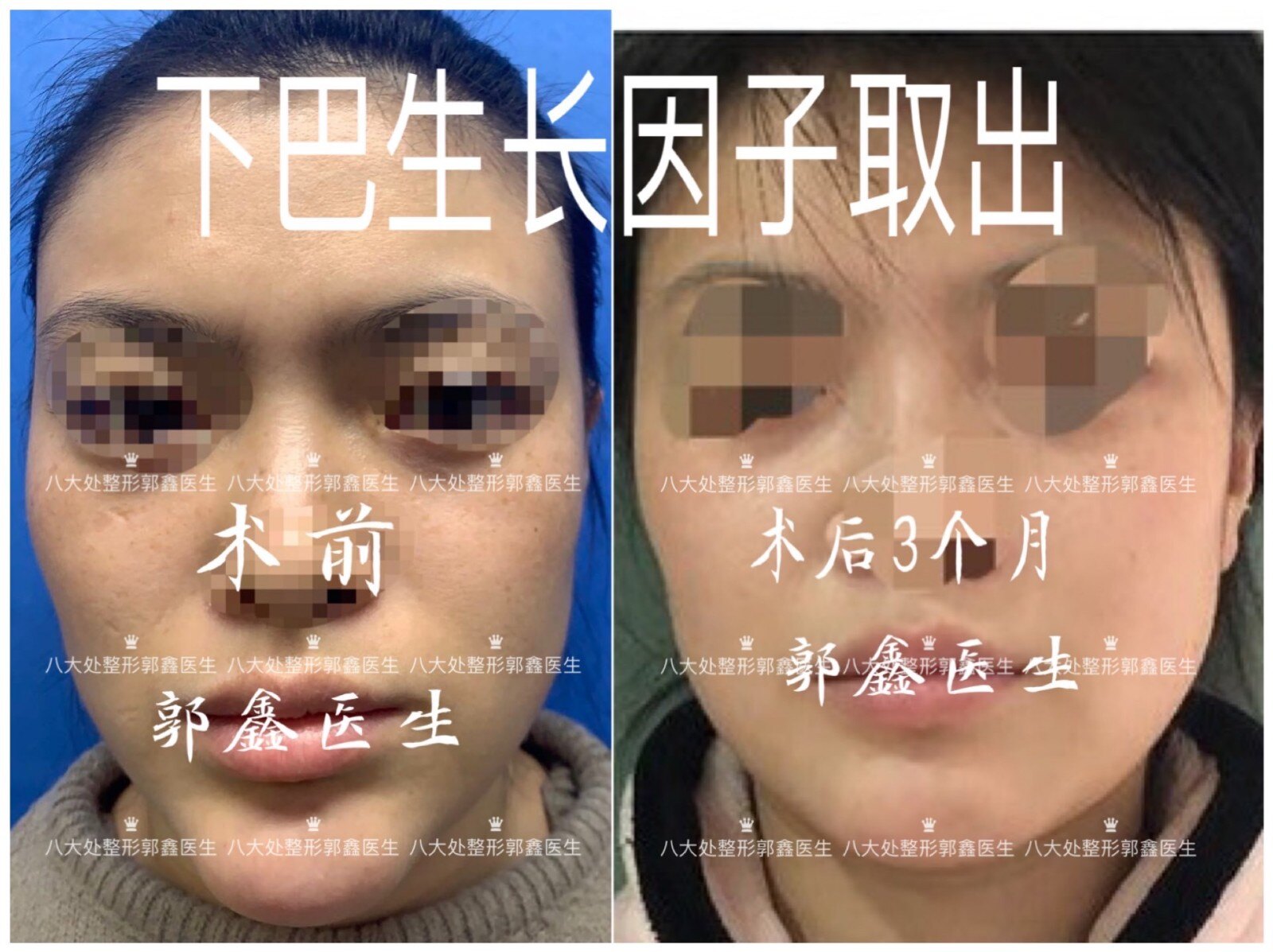 生长因子,童颜针,脂肪填充修复案例和简介(郭鑫医生)