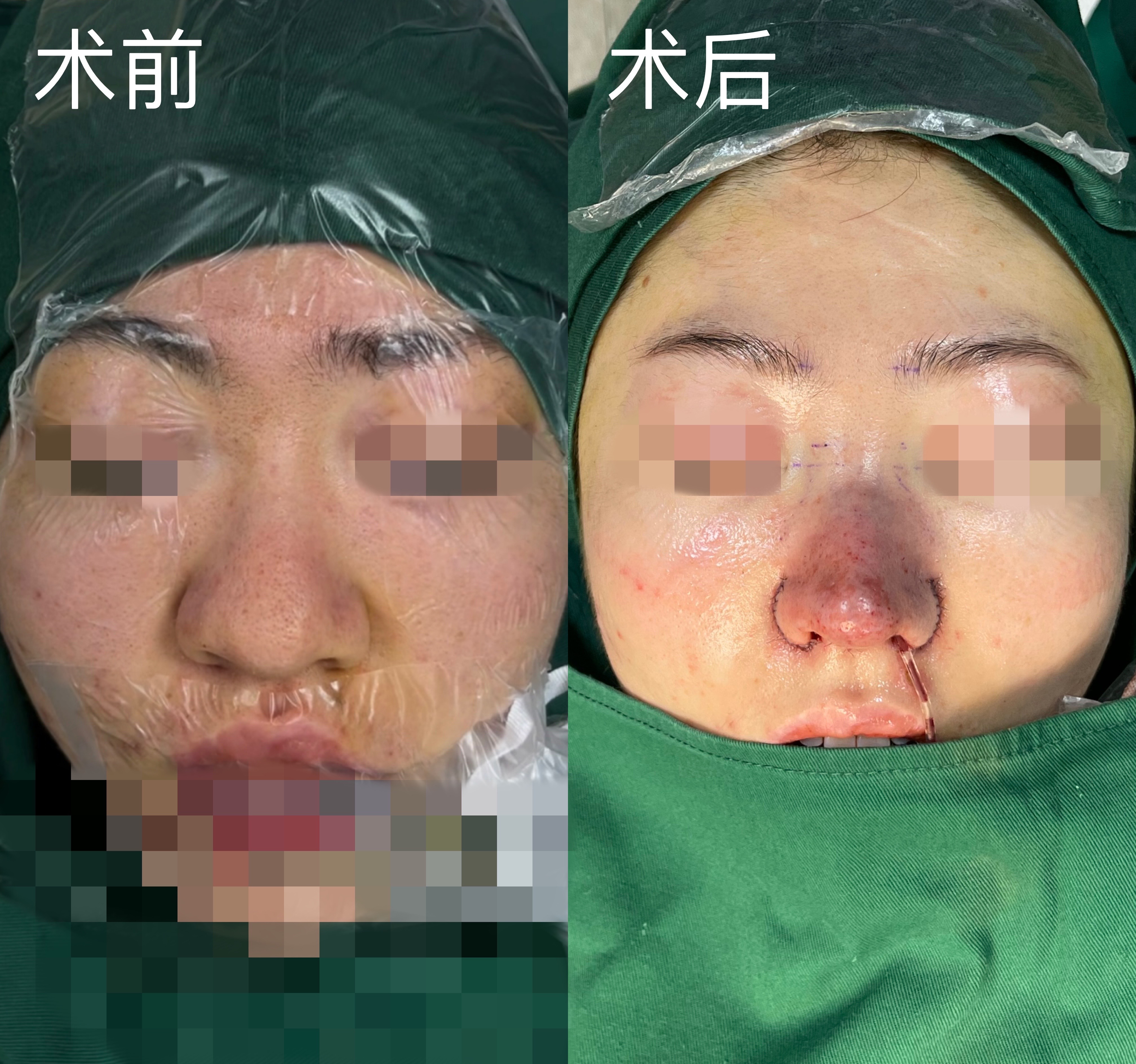 【鼻翼外扩以及其分型①】整形医生蒋立_鼻部整形_鼻部整形治疗介绍