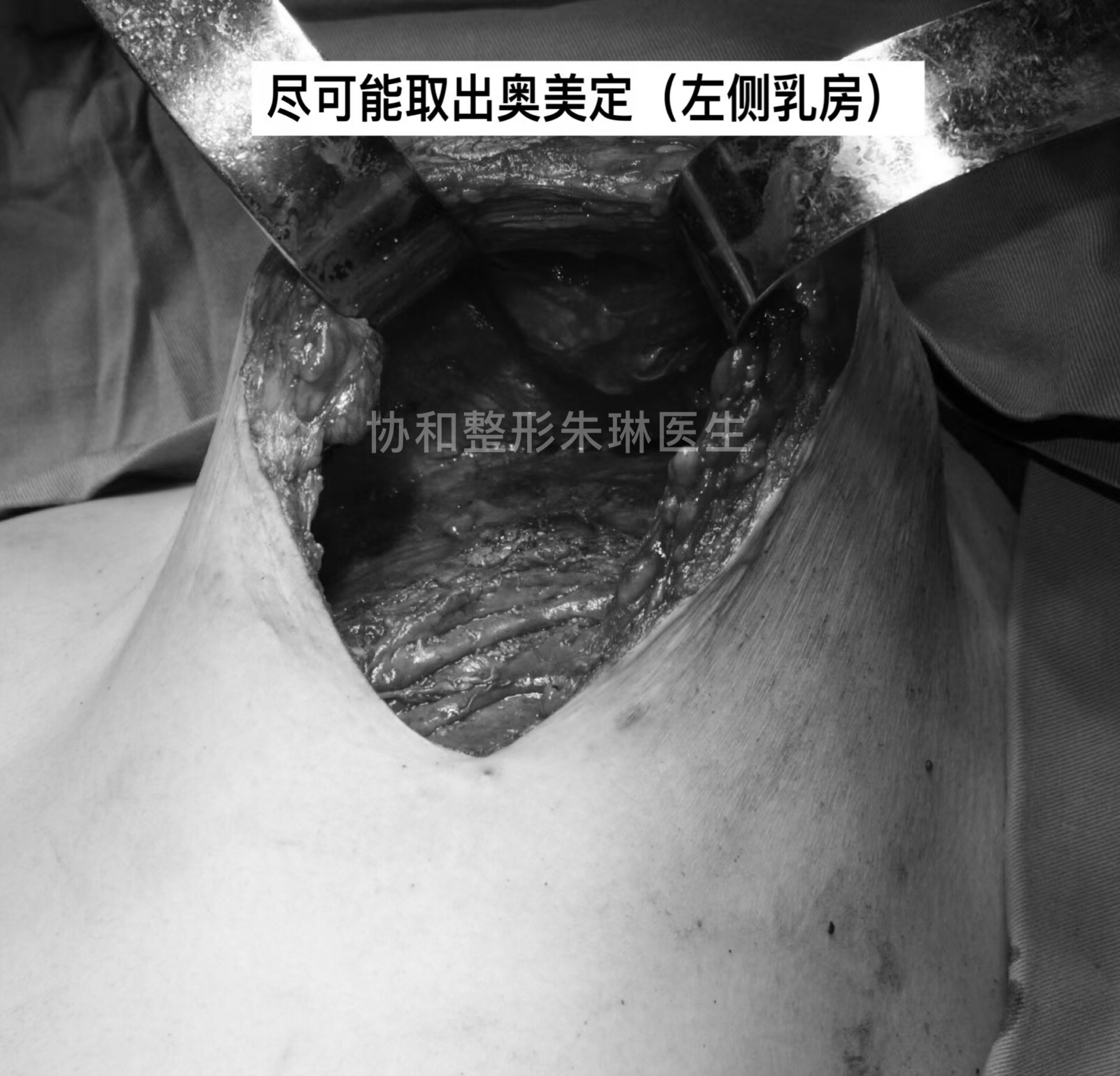 奥美定取出以后,胸部只能变得下垂吗?