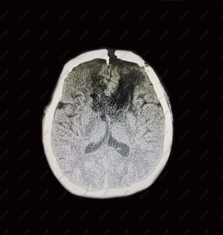 双额叶胼胝体胶质瘤_胶质瘤 - 好大夫在线