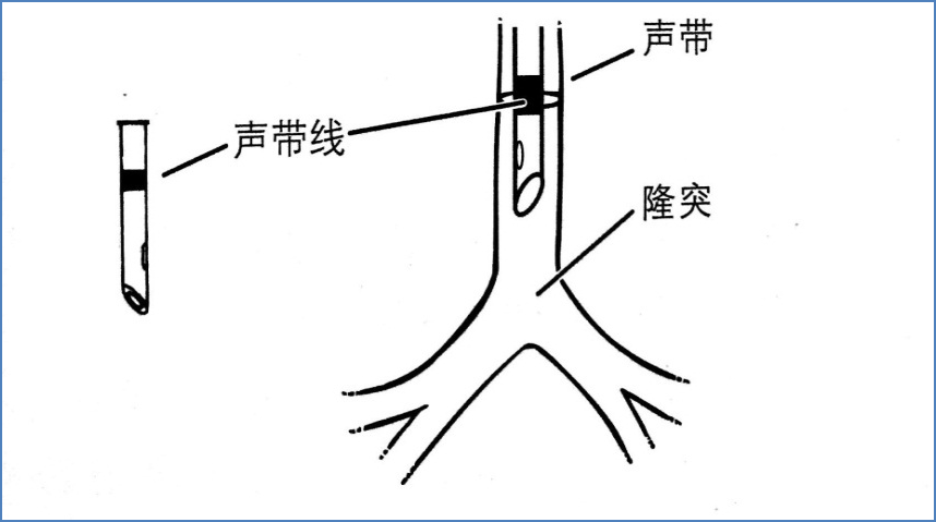 新生兒氣管插管