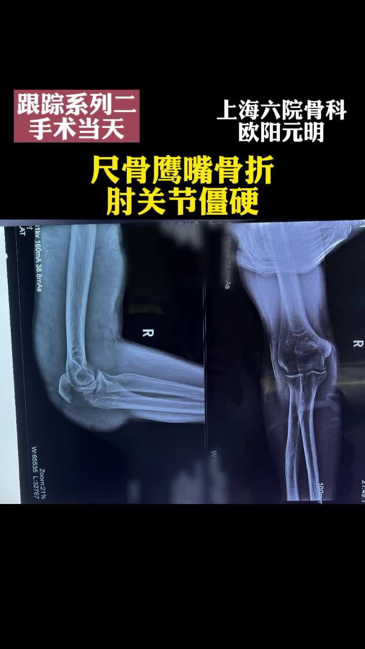 尺骨鹰嘴骨折肘关节僵硬手术当天 骨折 好大夫在线 尺骨鹰嘴骨折肘关节僵硬手术当天 骨折 好大夫在线