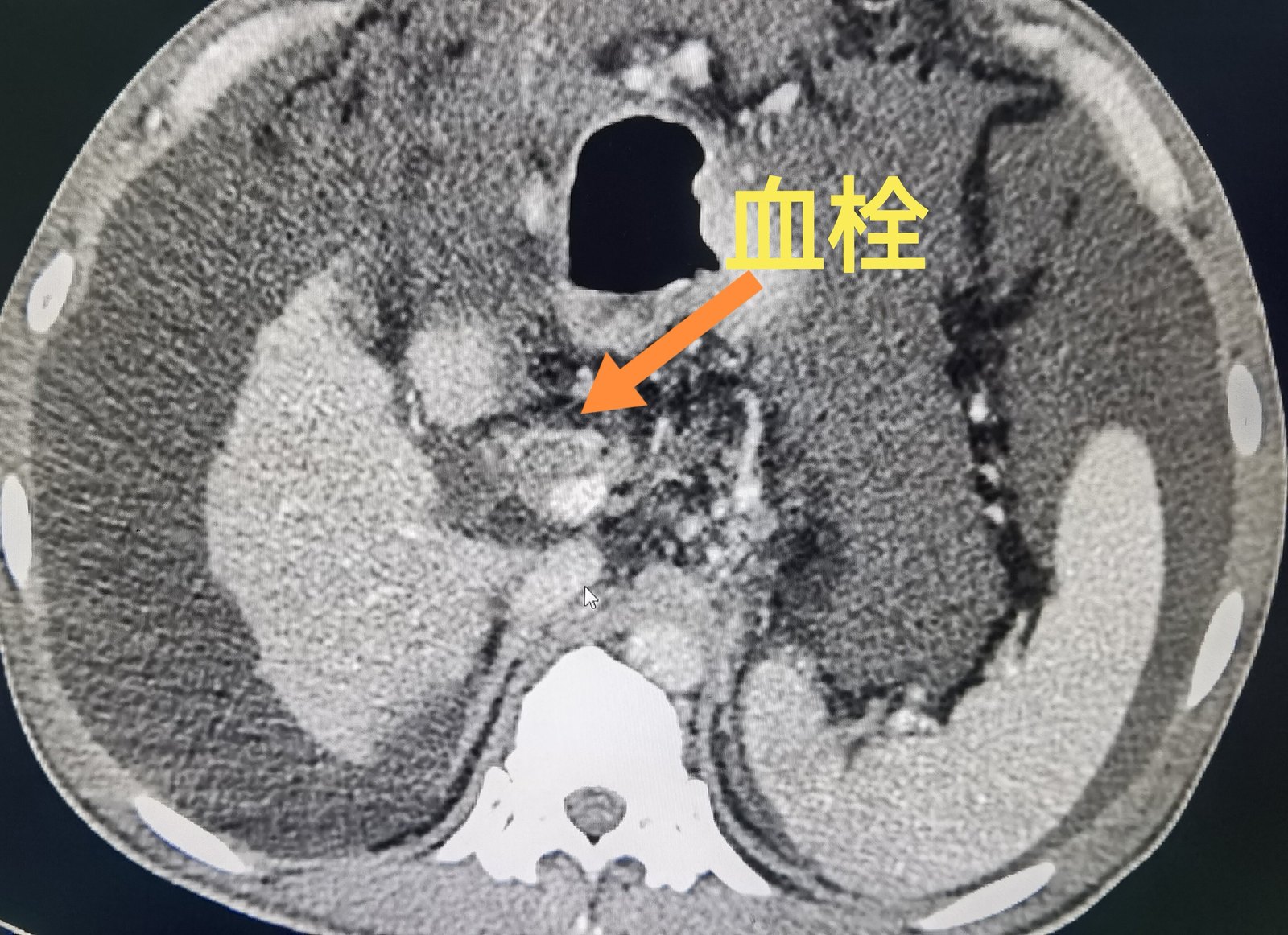 门静脉系统血栓-tips手术决策的"催化剂 - 好大夫在线
