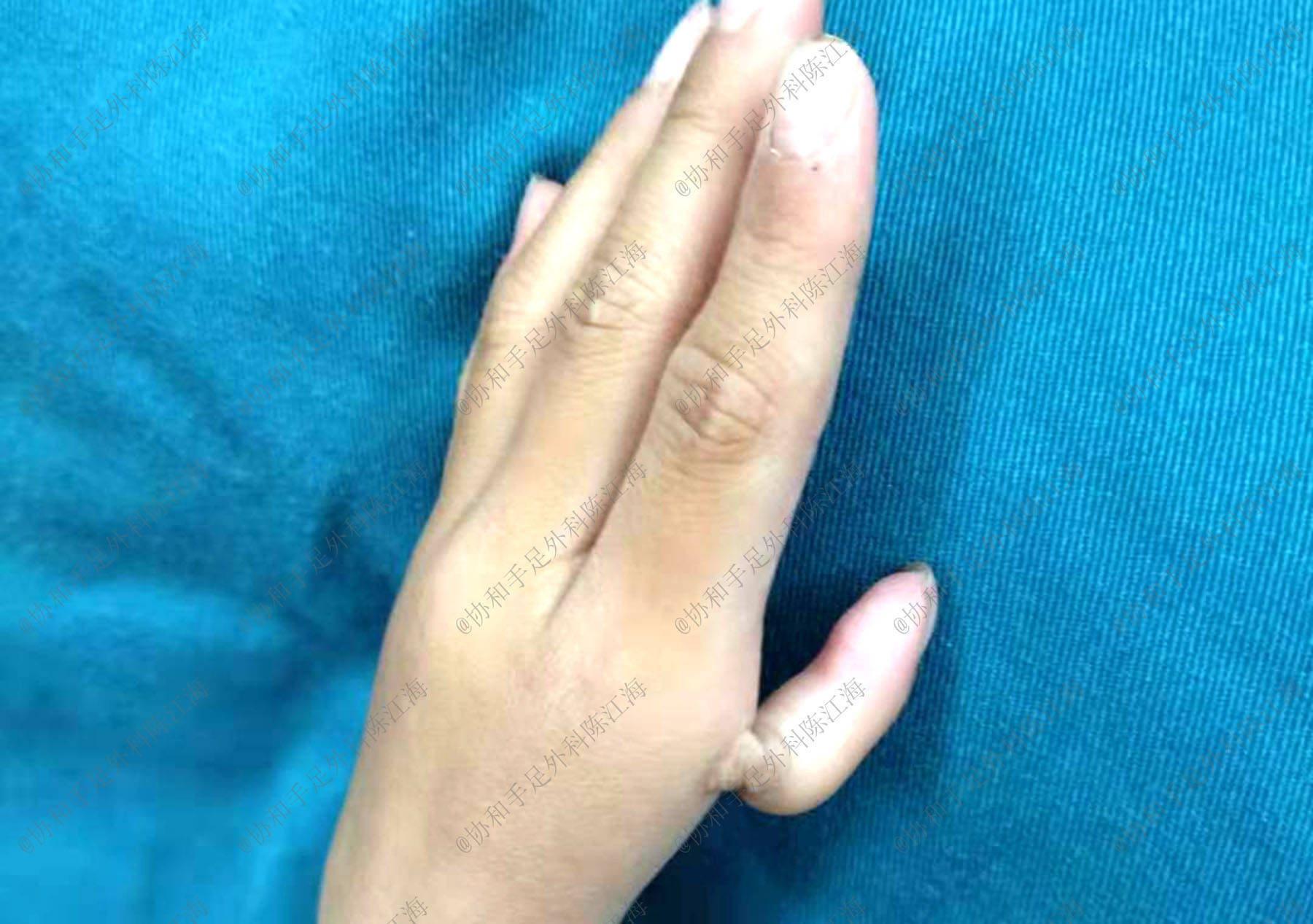 孩子拇指畸形漂浮拇,手术要趁早做,别拖! - 好大夫在线