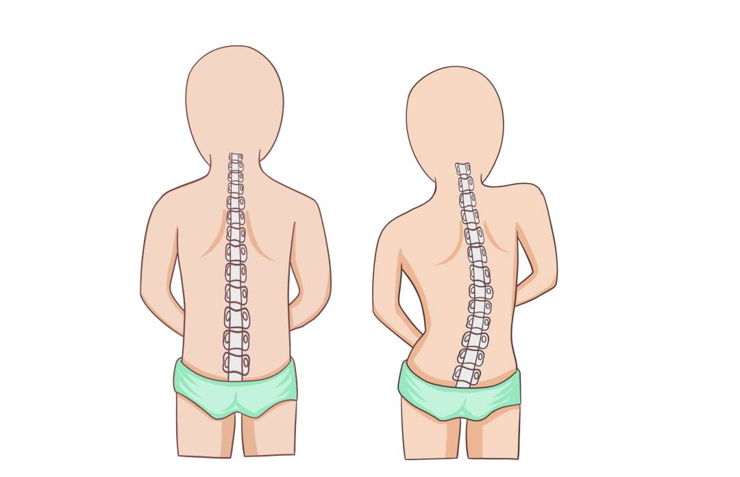 青少年特发性脊柱侧弯小知识