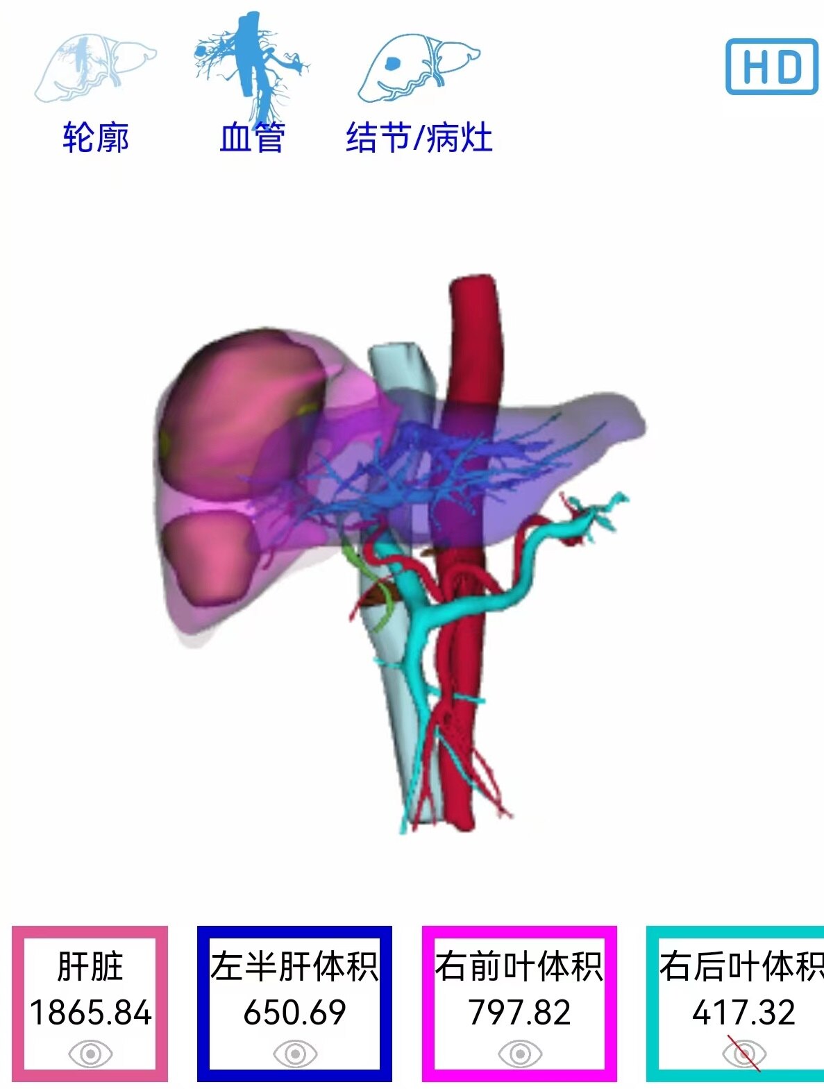 术后一个月体积.jpg