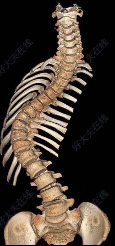 脊椎骨左侧凸起图片图片