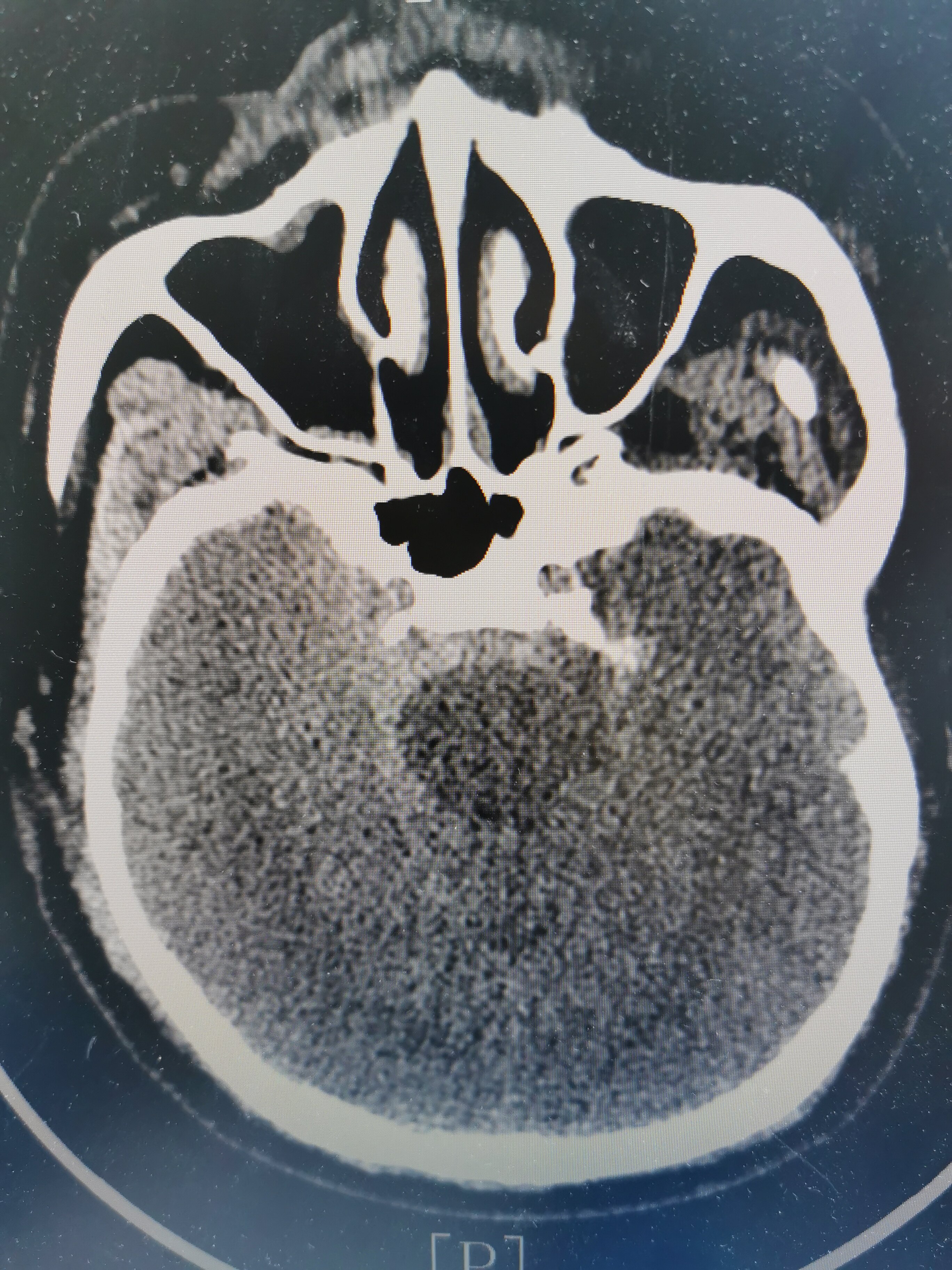 59岁男性患者,突发动脉瘤破裂出血1小时余, hunt