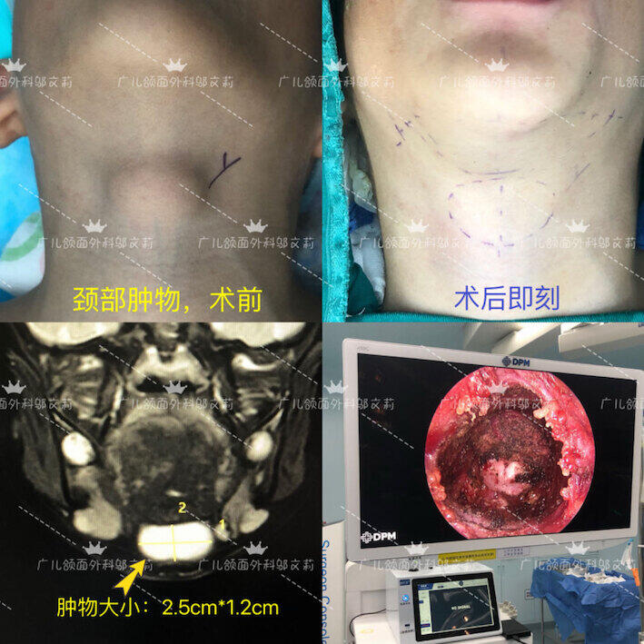 颈部肿物-1.jpg