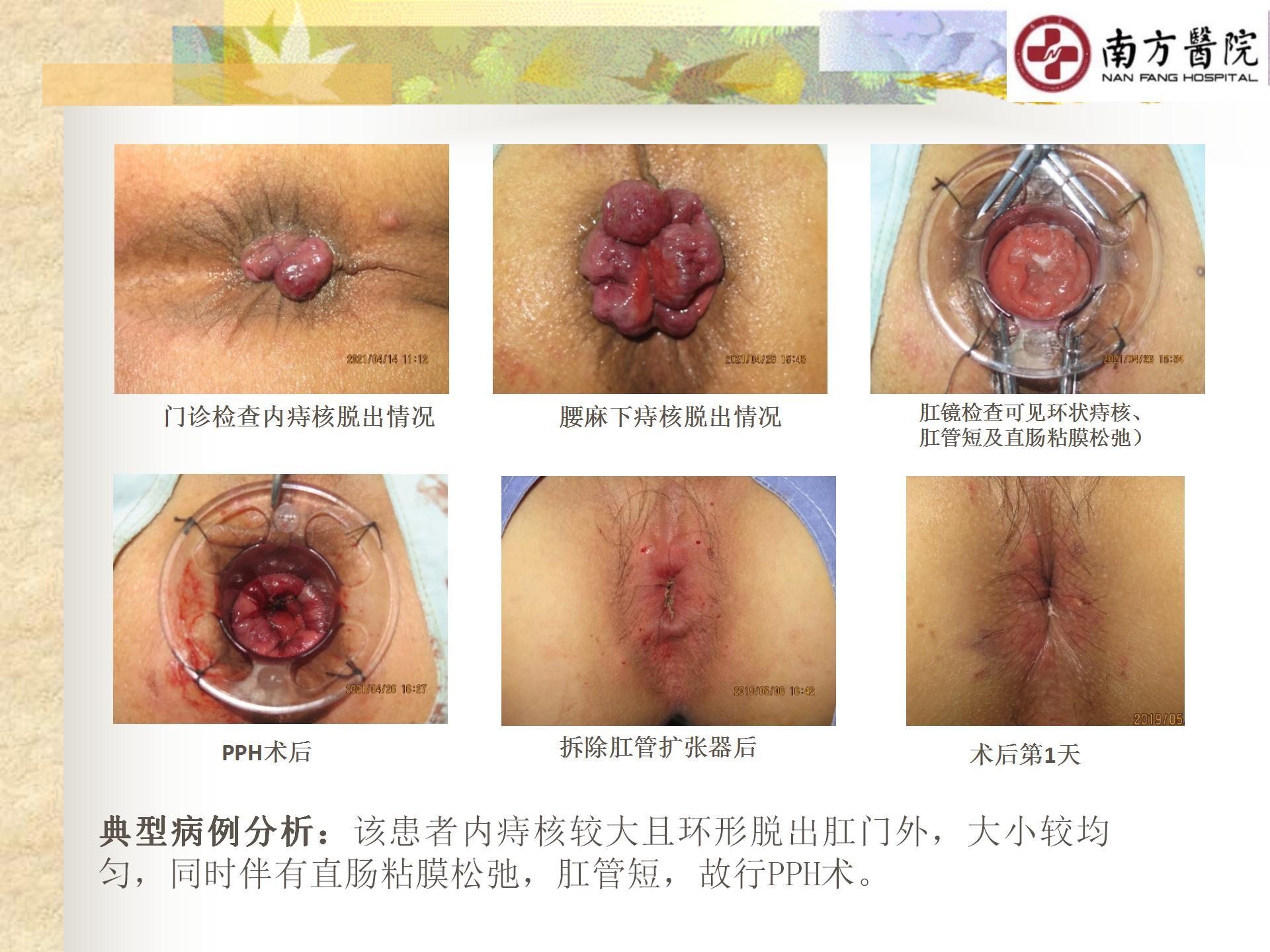 痔的精准化规范化微创化治疗之痔脱出1_26.jpg