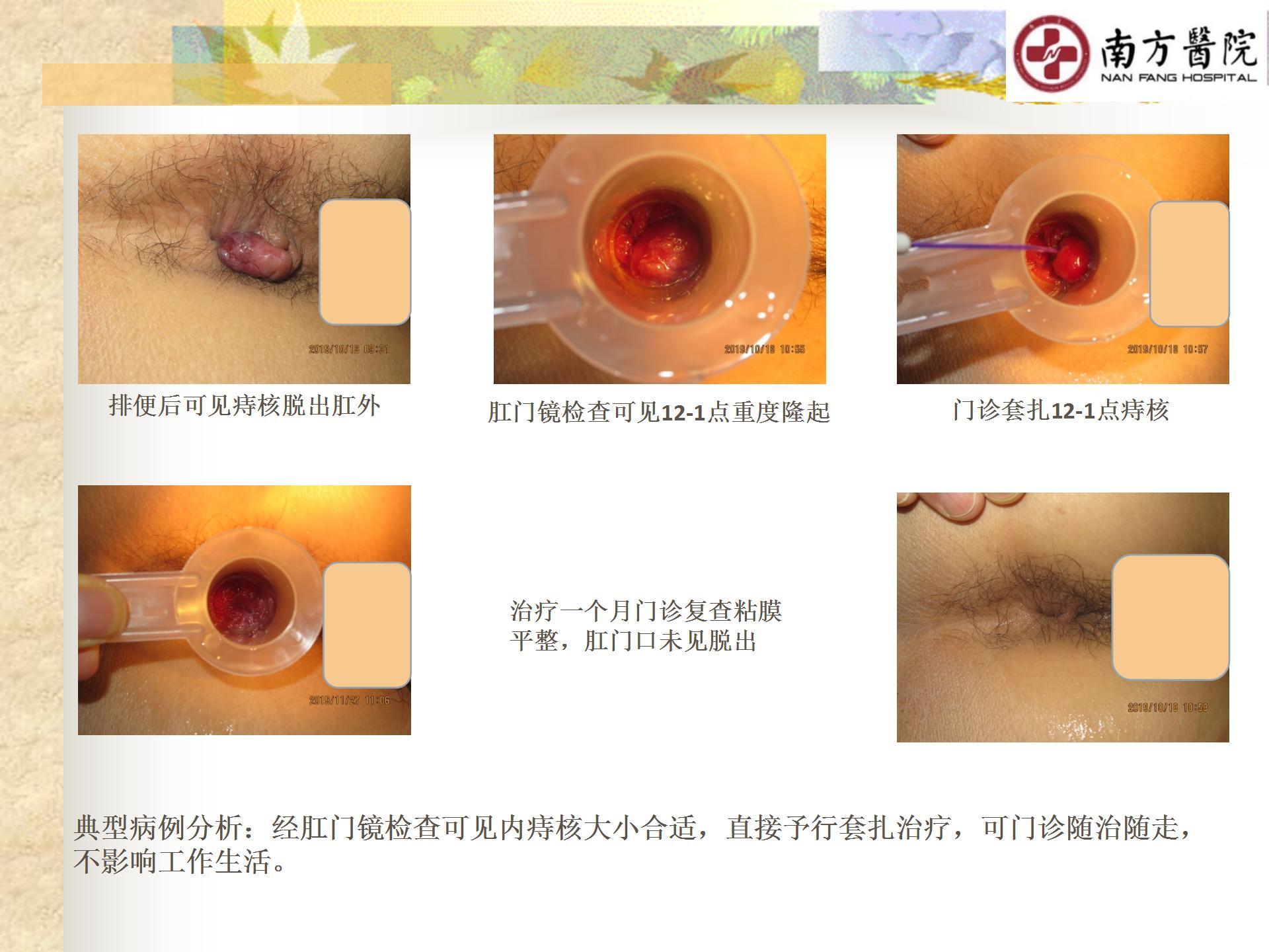 痔的精准化规范化微创化治疗之痔脱出1_09.jpg