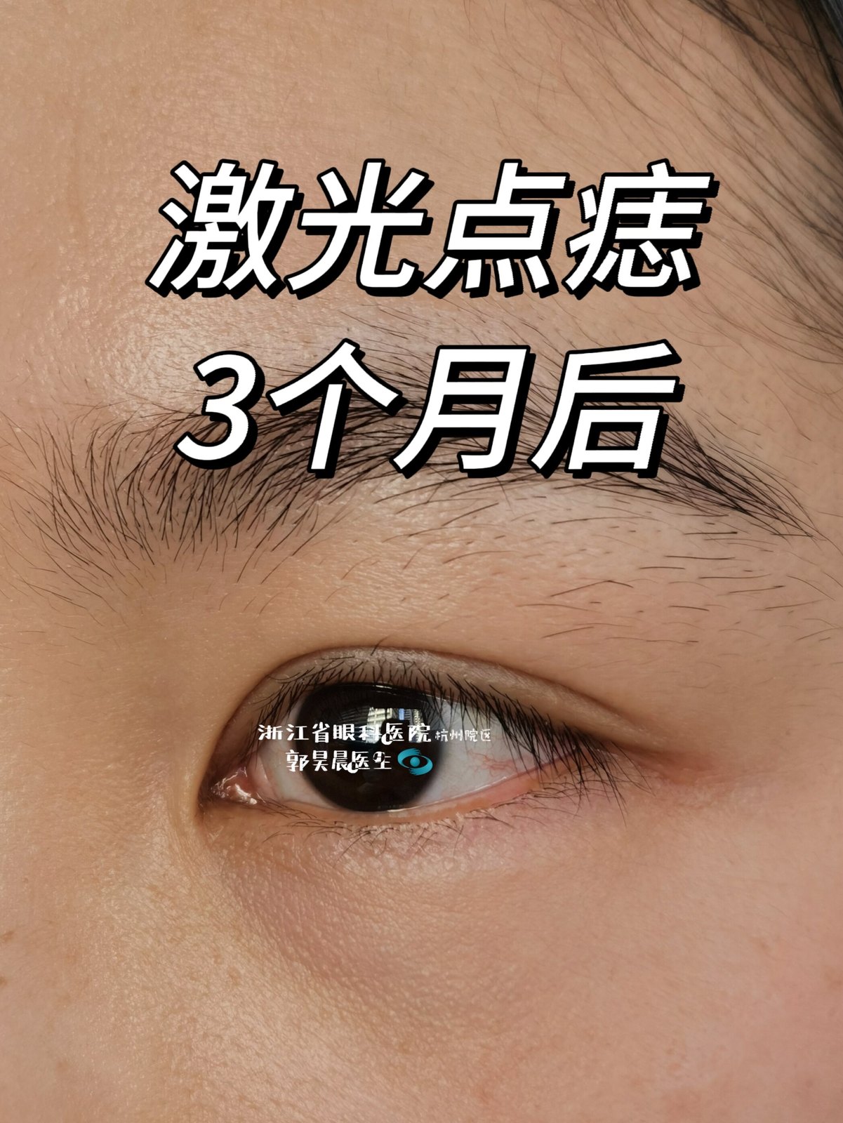 激光点痣3个月后