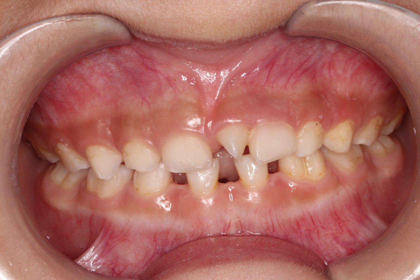 多生牙的小知识