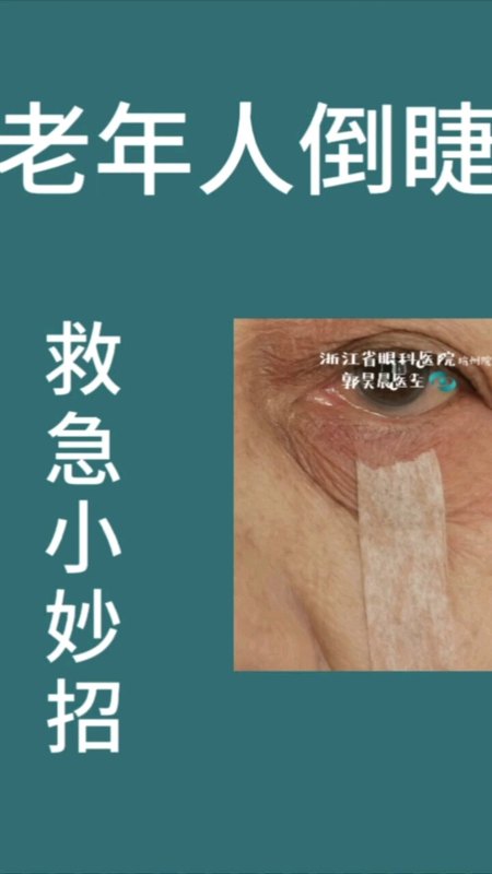老年人睑内翻倒睫救急小妙招