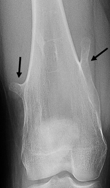 osteochondroma-bone-tumor-pedunculated.jpg