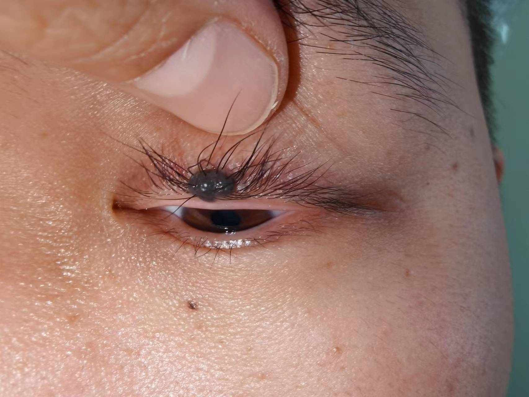 眼部肿瘤科普系列之眼黑色素的奥秘