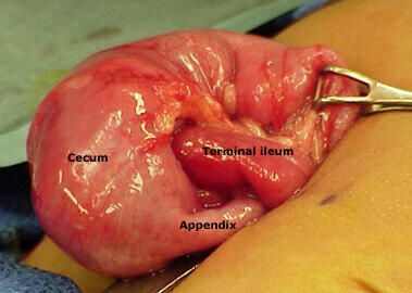 Ileocolonicintussusception.jpg