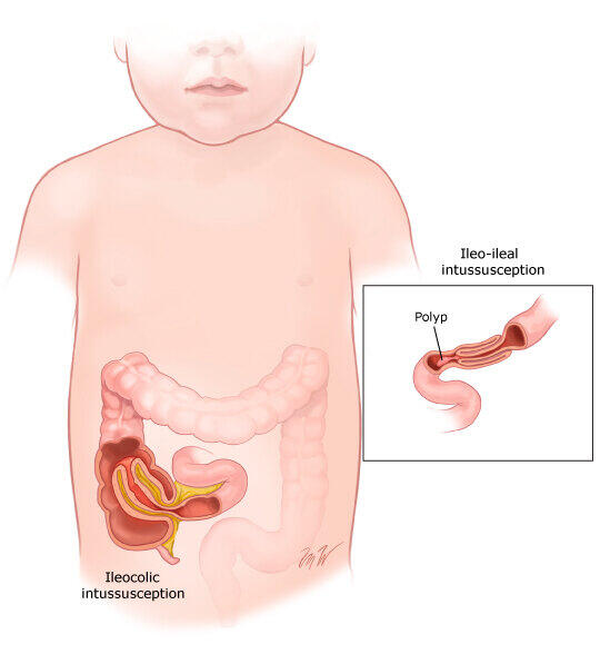 Illustrationofintussusception.jpg