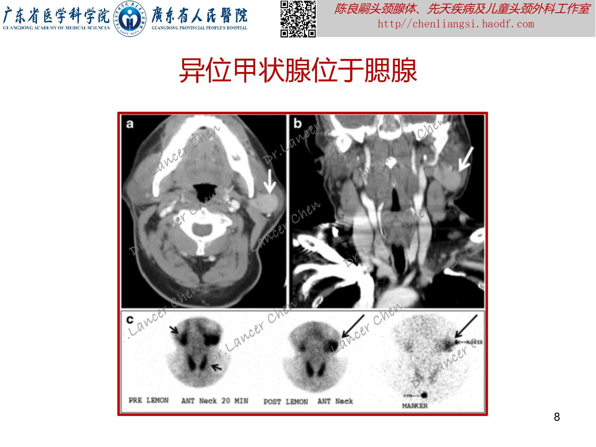 20230723：医学科普——貌似甲状舌管囊肿的罕见先天疾患——异位甲状腺_08.jpg