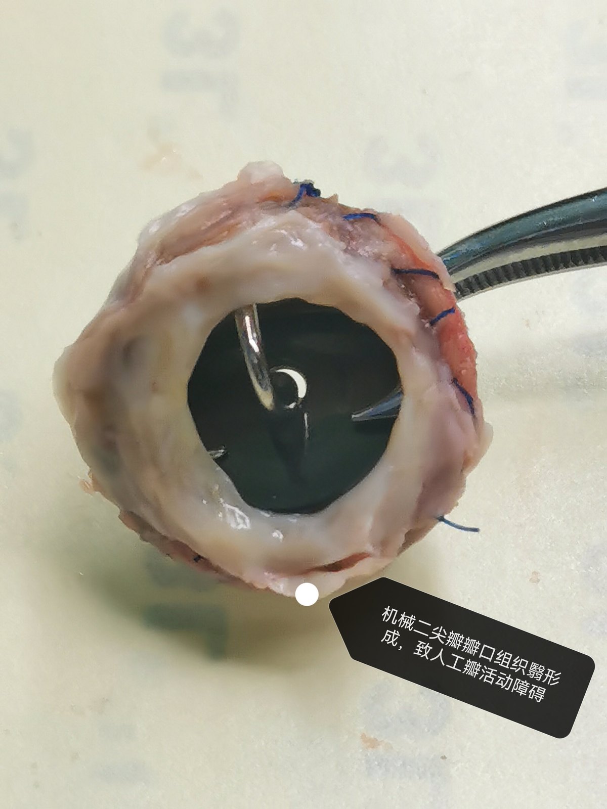 人工机械瓣膜瓣上或瓣下组织翳形成导致瓣口狭窄,瓣叶活动障碍