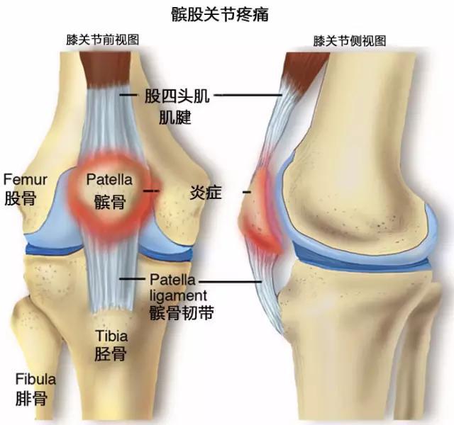 2,髌股关节疼痛综合征髂胫束摩擦综合征经常出现于自行车,长跑和竞走