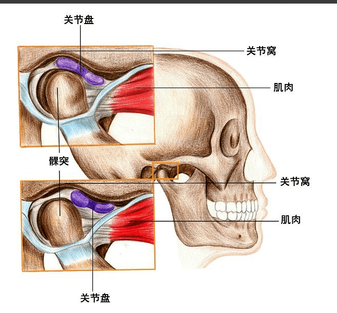 可复性关节盘前移位