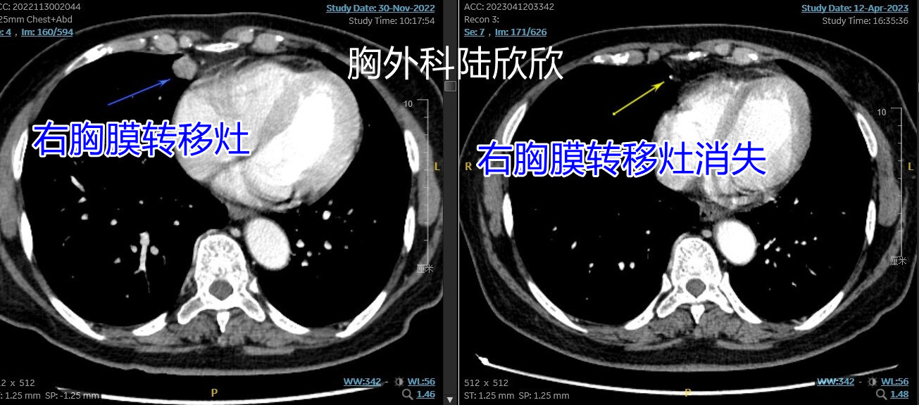 胸膜转移消失2 - 副本.jpg