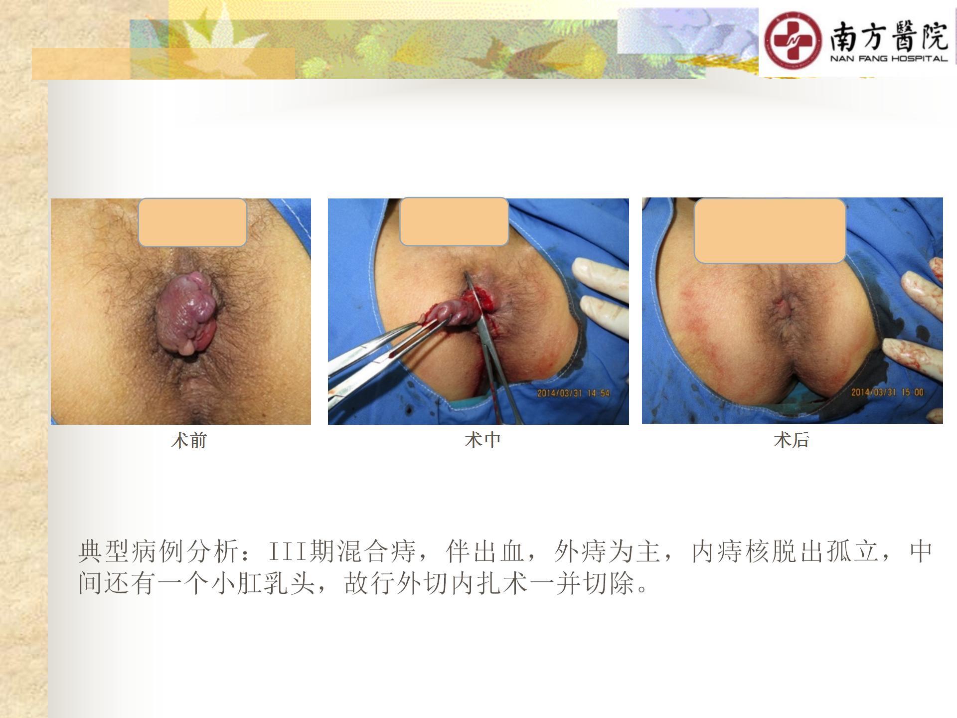 痔的精准化规范化微创化治疗之痔脱出3_09.jpg