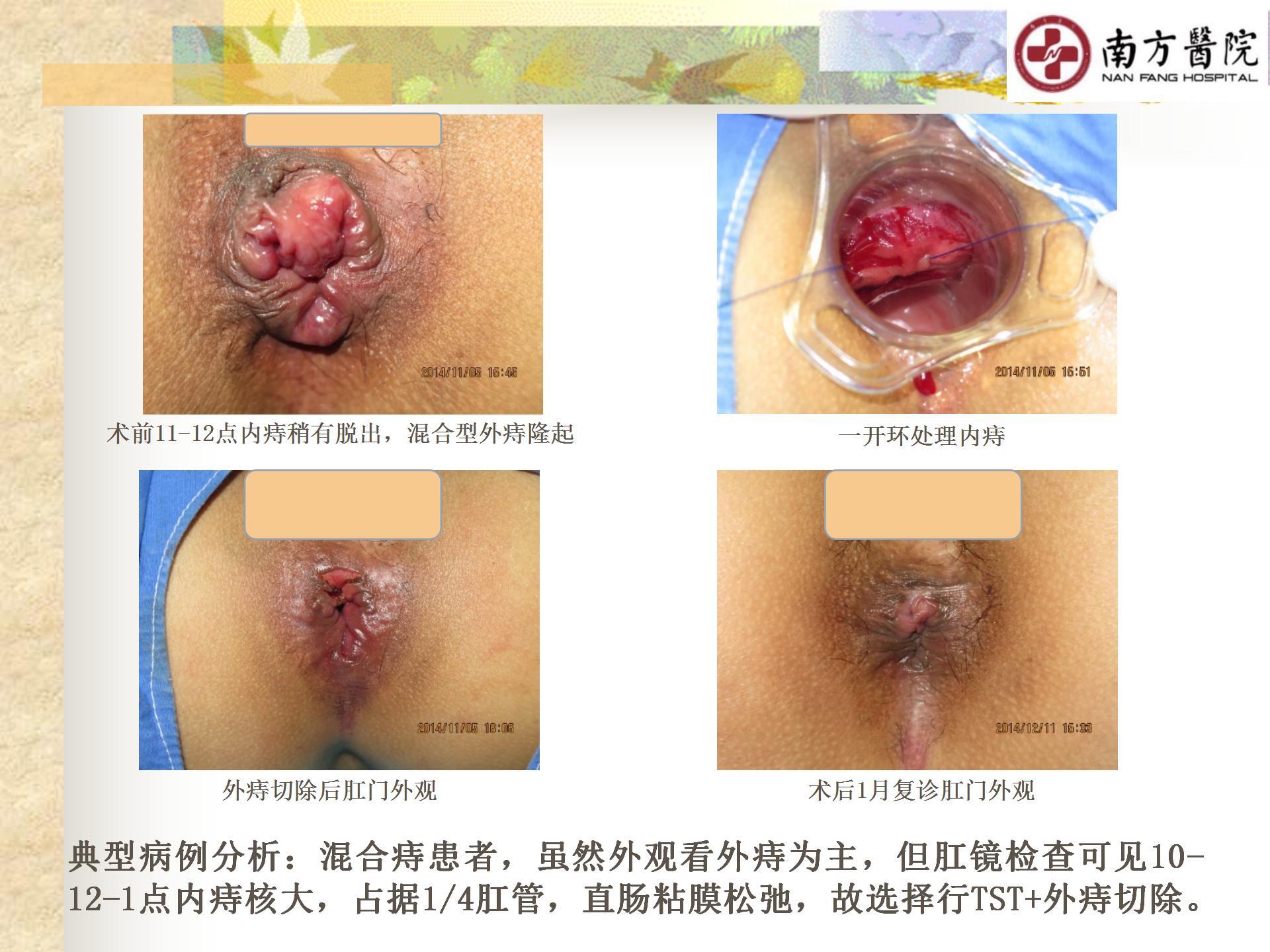 痔的精准化规范化微创化治疗之痔脱出3_18.jpg
