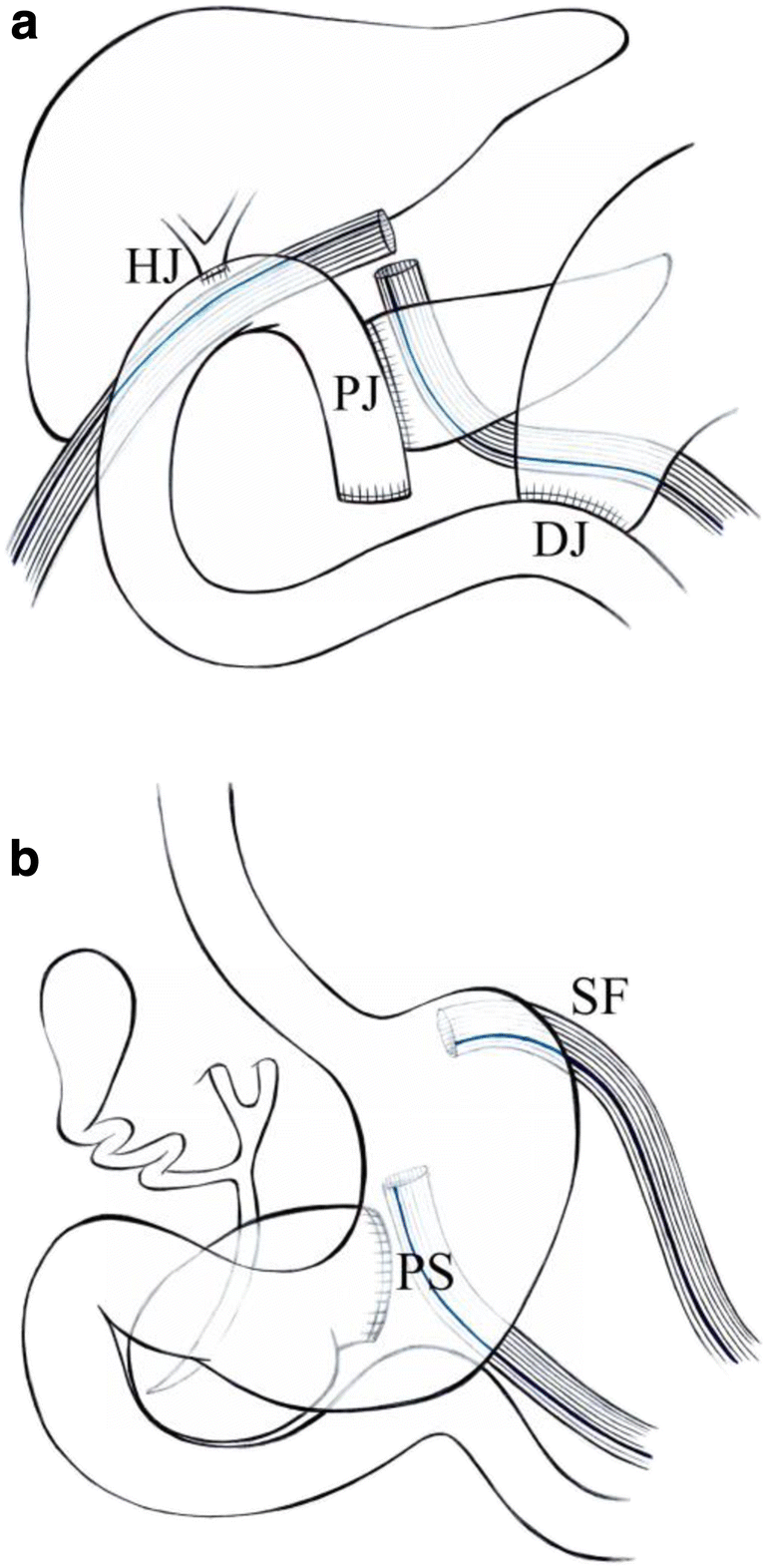 a-Standard-drains-position-after-pancreatoduodenectomy-PD-PJ-pancreatojejunostomy.png