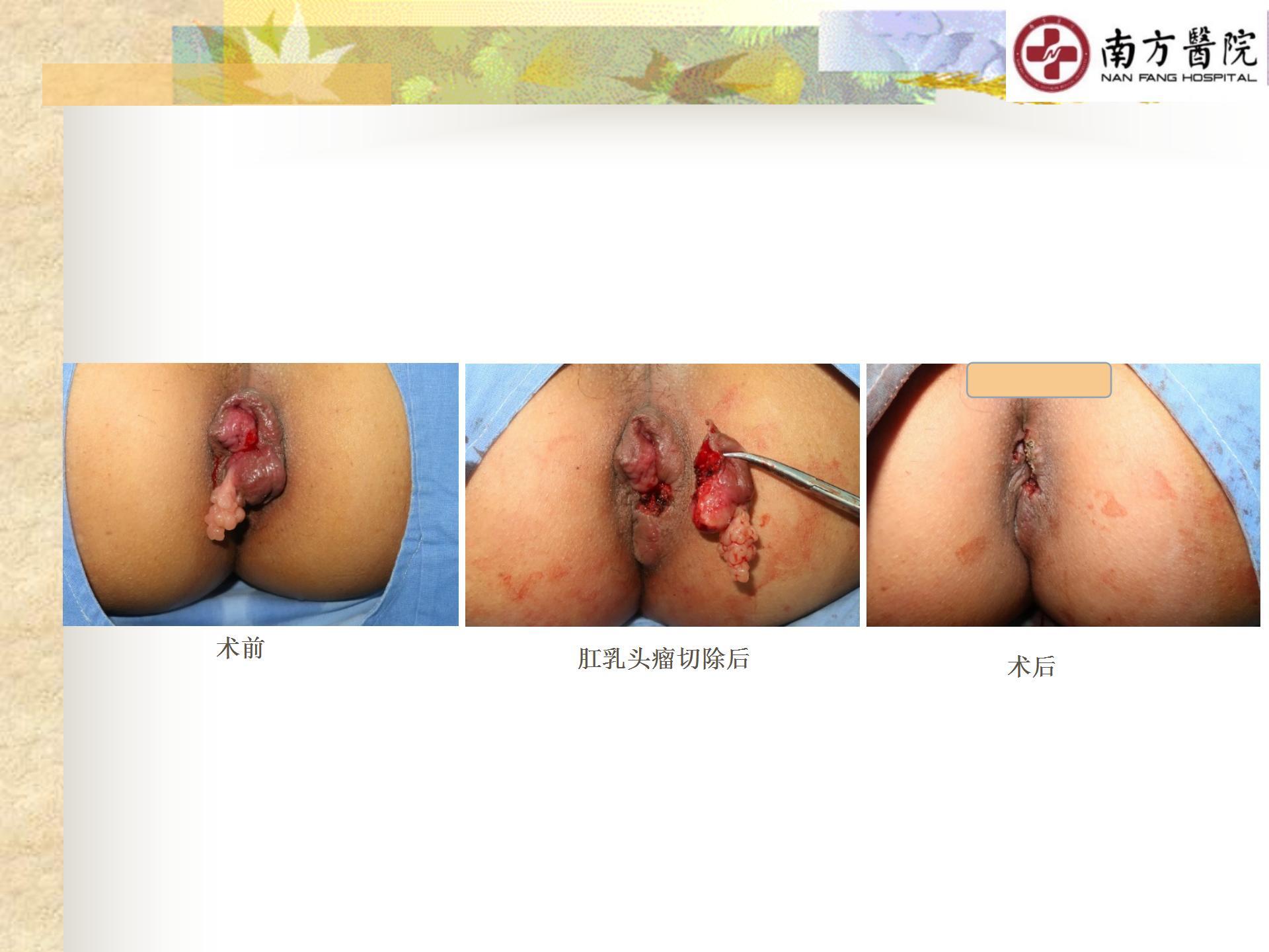 痔的精准化规范化微创化治疗之痔脱出3_11.jpg