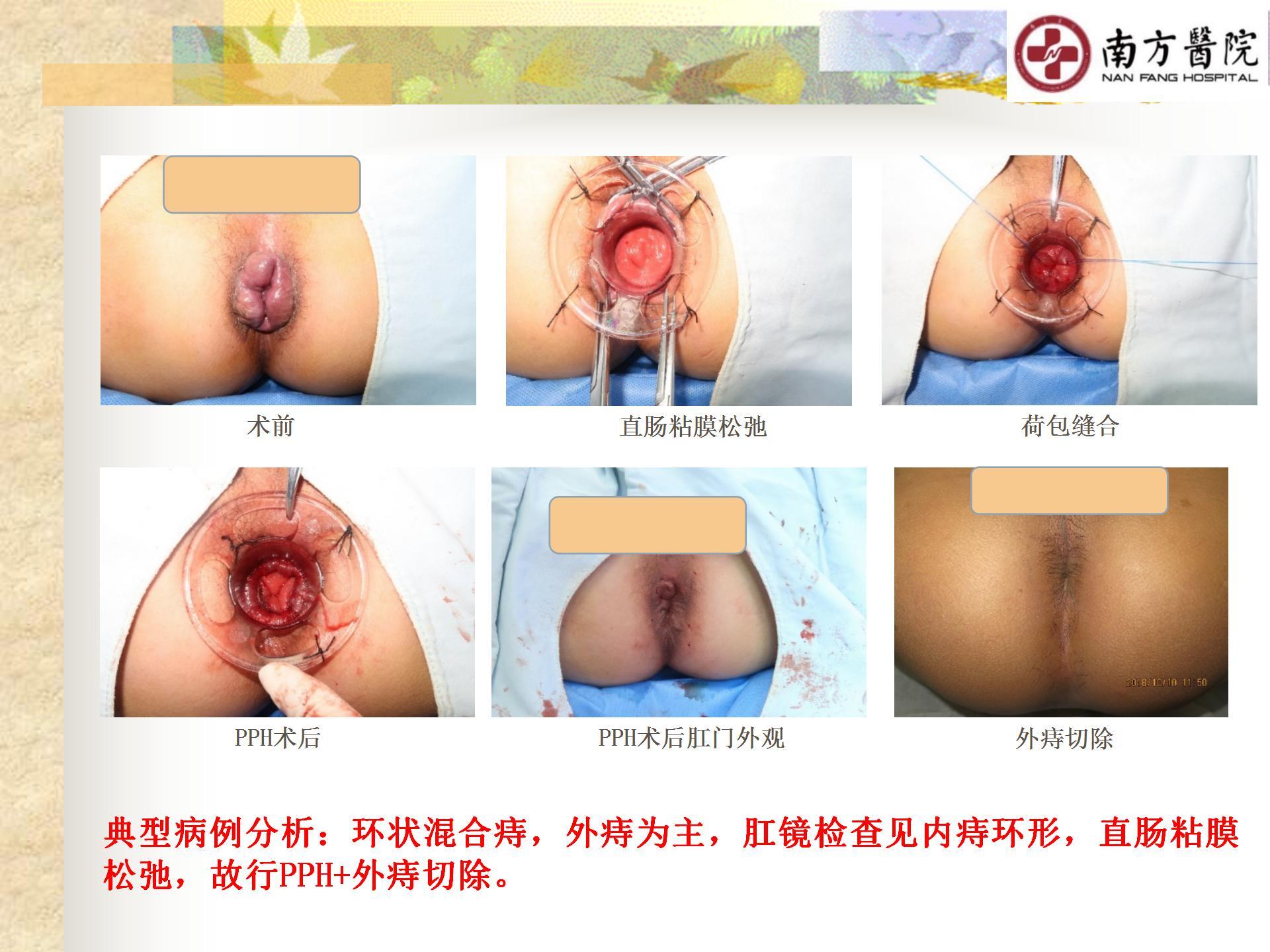 痔的精准化规范化微创化治疗之痔脱出3_30.jpg
