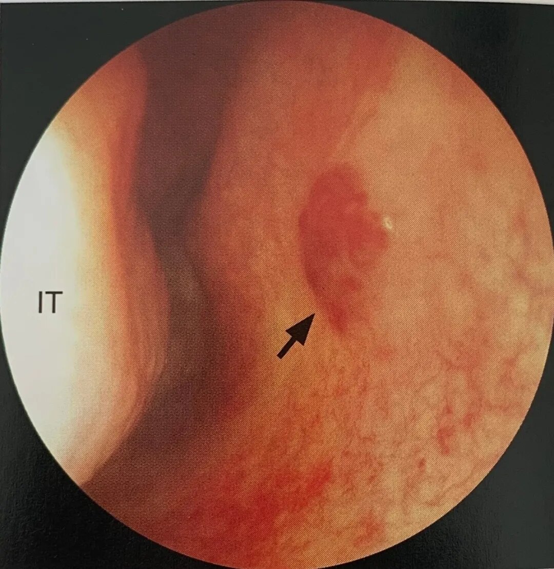 科普鼻出血我们该如何处理