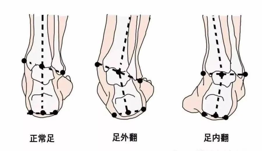 膝关节疼痛?可能是足外翻引起的!_足外翻_相关疾病_症状表现 - 好大夫在线