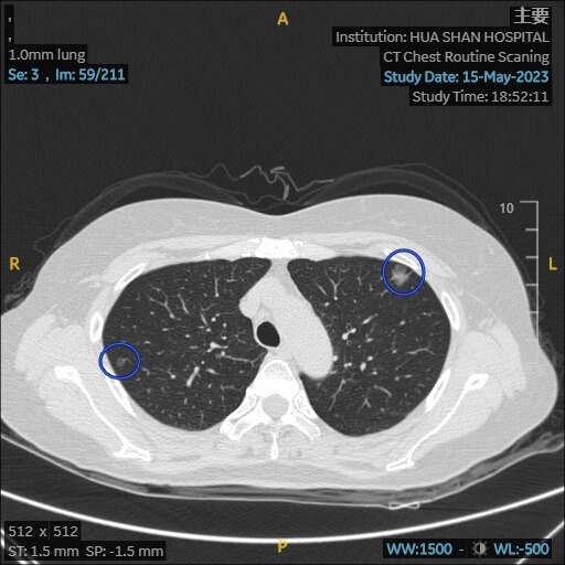 CT Chest Routine Scaning.1.0mm lung.Se 3.Img 59-211.jpg